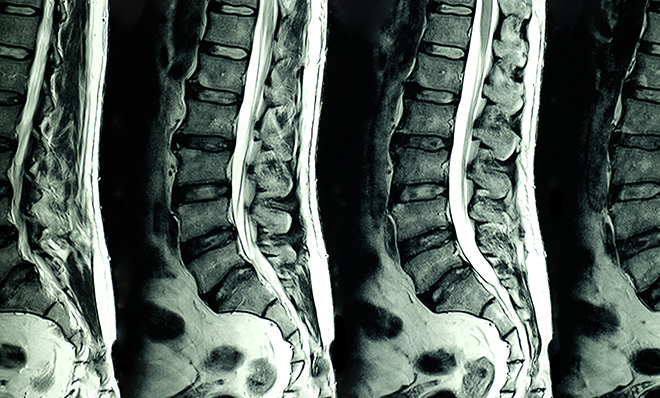 mris-in-the-world-of-personal-injury-mri-scan-review-doctors-on-liens-spinal-image