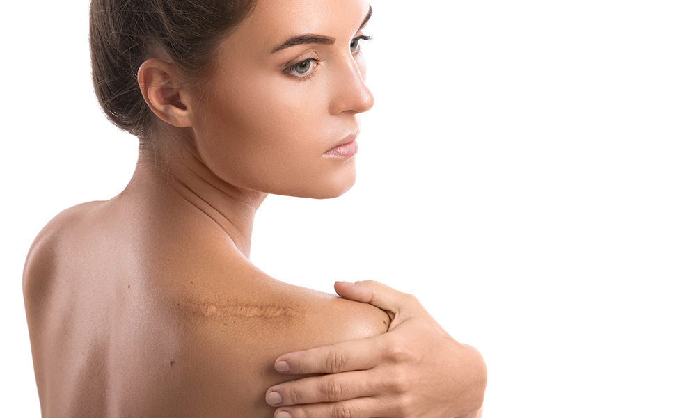 how-to-minimize-the-appearance-of-scars-woman-with-scar-on-her-back
