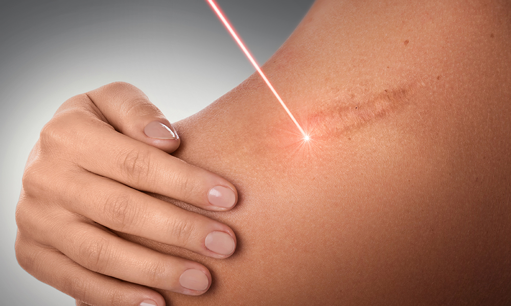 how-to-deal-with-hyperpigmented-scars-main-image-laser-scar-treatment
